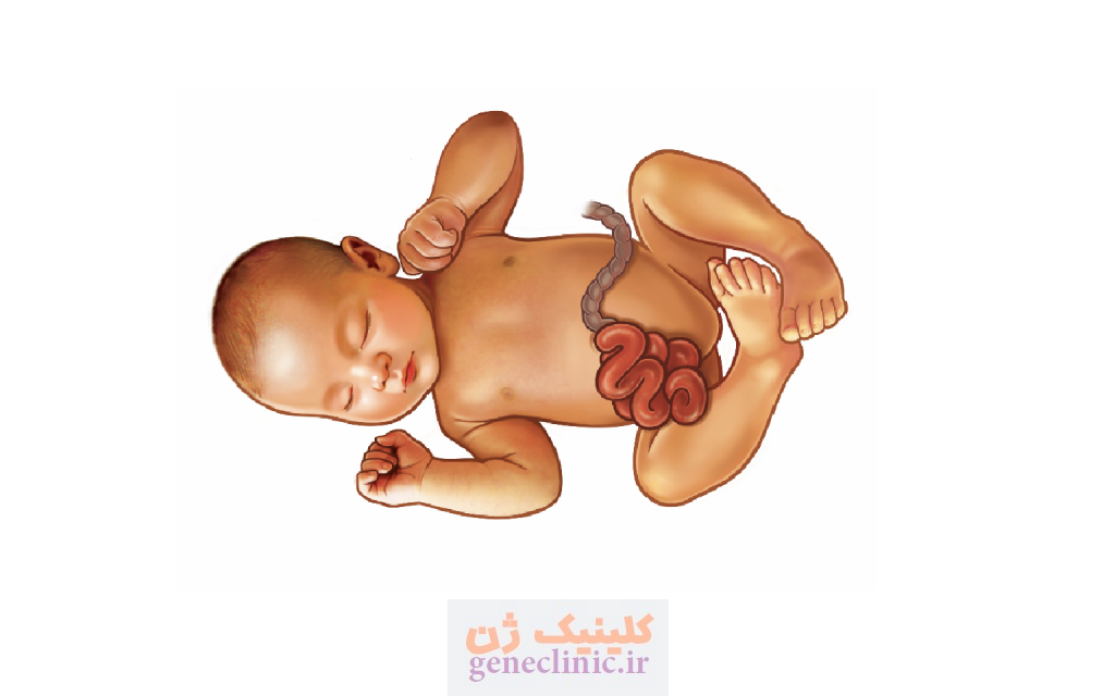 گاستروشزی (Gastroschisis) چیست؟