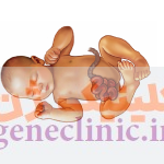 گاستروشزی (Gastroschisis) چیست؟