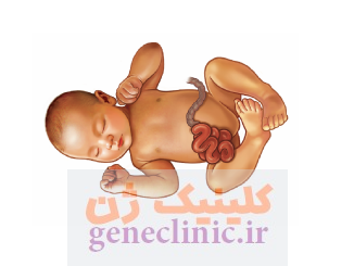گاستروشزی (Gastroschisis) چیست؟
