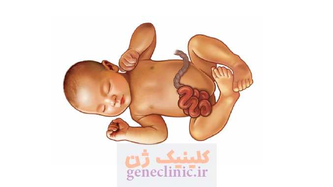 گاستروشزی (Gastroschisis) چیست؟ گاستروشزی (Gastroschisis) چیست؟