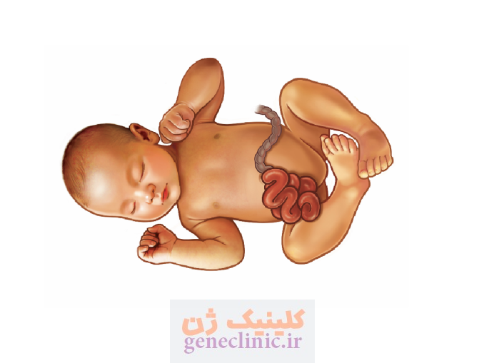 گاستروشزی (Gastroschisis) چیست؟