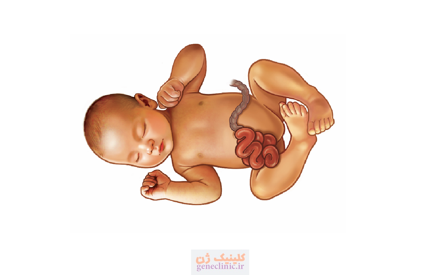 گاستروشزی (Gastroschisis) چیست؟