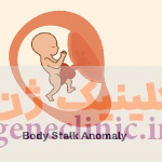 ‏ناهنجاری ساقه بدن‏ (Body stalk anomaly) چیست؟