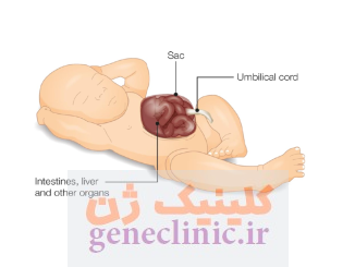 اگزومفالوس‏ (Exomphalos) چیست؟