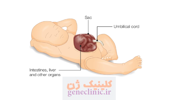 اگزومفالوس‏ (Exomphalos) چیست؟