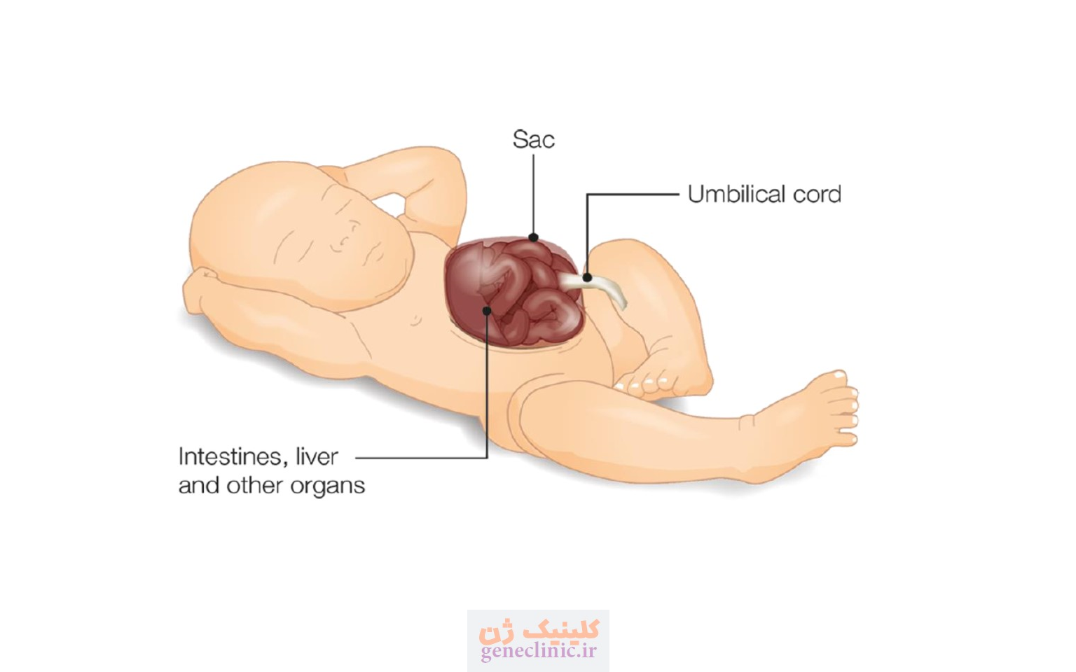 اگزومفالوس‏ (Exomphalos) چیست؟