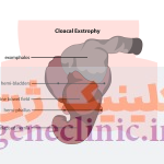 ‏اکستروفی کلوآک (Cloacal exstrophy) چیست؟