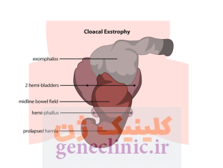 ‏اکستروفی کلوآک (Cloacal exstrophy) چیست؟