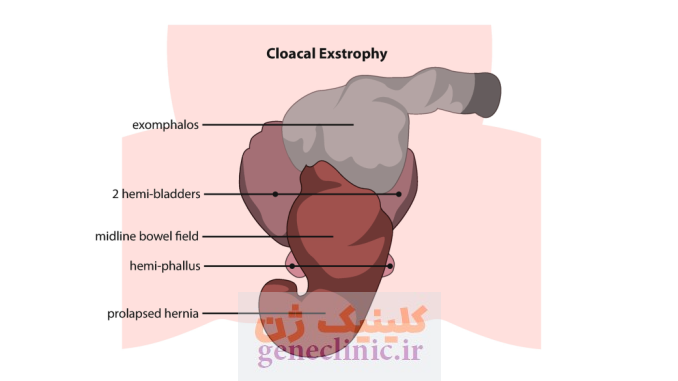 ‏اکستروفی کلوآک (Cloacal exstrophy) چیست؟