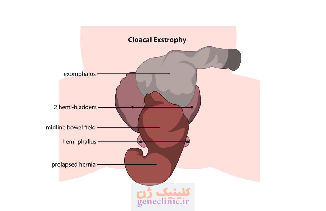 ‏اکستروفی کلوآک (Cloacal exstrophy) چیست؟