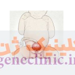 ‏اکستروفی مثانه‏ (Bladder exstrophy) چیست؟