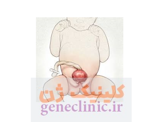 ‏اکستروفی مثانه‏ (Bladder exstrophy) چیست؟