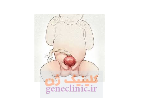 ‏اکستروفی مثانه‏ (Bladder exstrophy) چیست؟