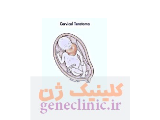 تراتوم گردن (Cervical teratoma) چیست؟