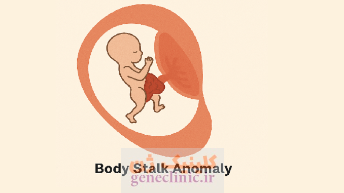 ناهنجاری ساقه بدن (Body stalk anomaly) چیست؟ ناهنجاری ساقه بدن (Body stalk anomaly) چیست؟