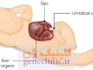 اگزومفالوس‏ (Exomphalos) چیست؟