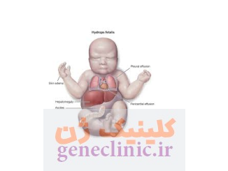 هیدروپس فتالیس یا هیدروپس جنینی (Hydrops fetalis) چیست؟