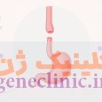 ‏آترزی مری‏ (Esophageal atresia) چیست؟