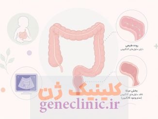 ‏بیماری هیرشپرونگ‏ (Hirschsprung's disease) چیست؟