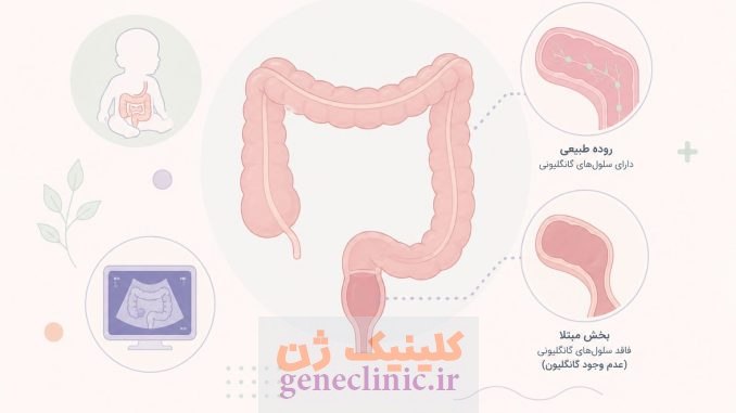 ‏بیماری هیرشپرونگ‏ (Hirschsprung's disease) چیست؟