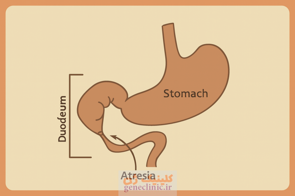 ‏آترزی دوازدهه‏ (دئودنوم) (Duodenal atresia) چیست؟