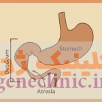 آترزی دوازدهه (دئودنوم) (Duodenal atresia) آترزی دوازدهه (دئودنوم) (Duodenal atresia) چیست؟