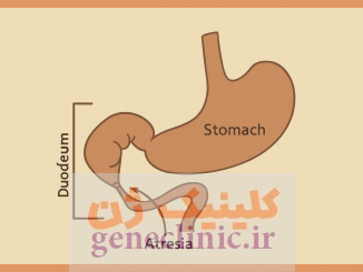 ‏آترزی دوازدهه‏ (دئودنوم) (Duodenal atresia) چیست؟