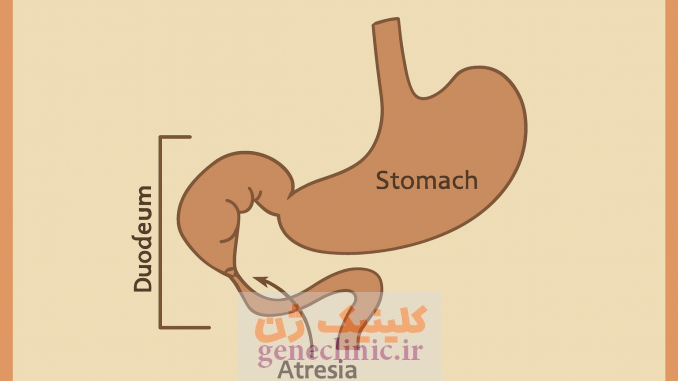 ‏آترزی دوازدهه‏ (دئودنوم) (Duodenal atresia) چیست؟