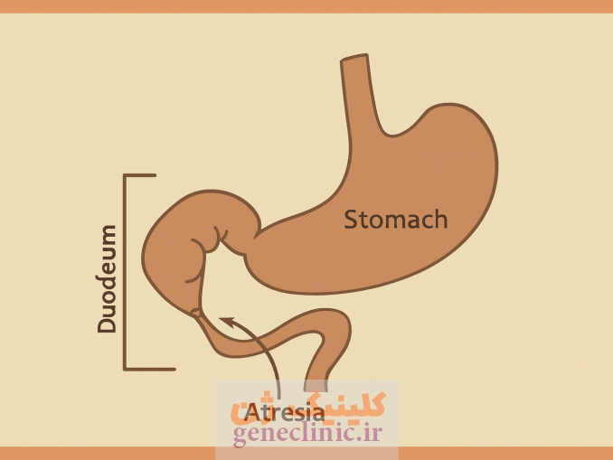 ‏آترزی دوازدهه‏ (دئودنوم) (Duodenal atresia) چیست؟