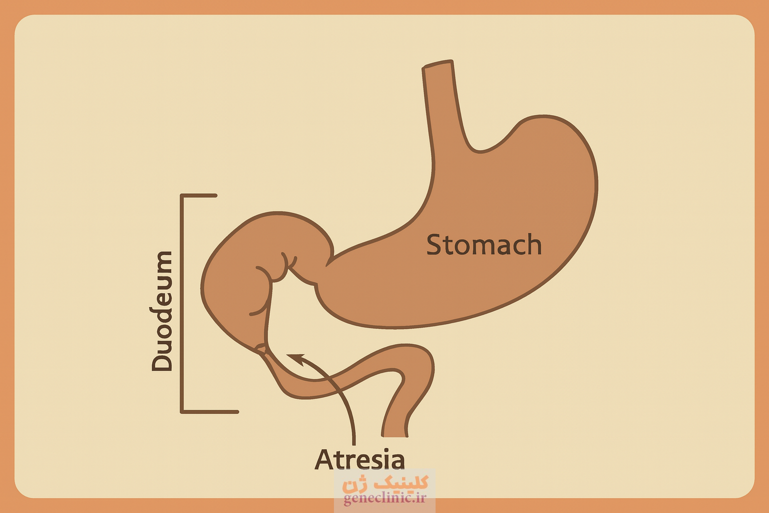 ‏آترزی دوازدهه‏ (دئودنوم) (Duodenal atresia) چیست؟