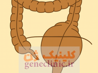 ‏بیماری هیرشپرونگ‏ (Hirschsprung's disease) چیست؟