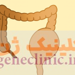 ‏بیماری هیرشپرونگ‏ (Hirschsprung's disease) چیست؟