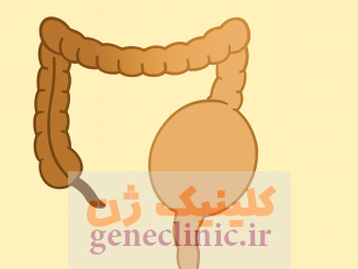 ‏بیماری هیرشپرونگ‏ (Hirschsprung's disease) چیست؟
