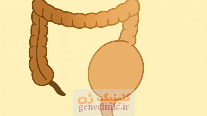 ‏بیماری هیرشپرونگ‏ (Hirschsprung's disease) چیست؟