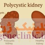 کلیه چندکیستی (Multicystic kidney) چیست؟