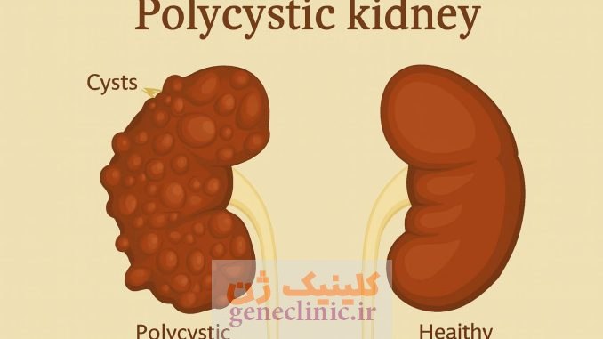 کلیه چندکیستی (Multicystic kidney) چیست؟