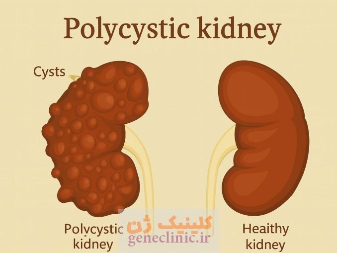 کلیه چندکیستی (Multicystic kidney) چیست؟
