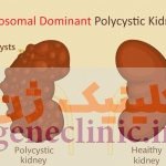 ‏کلیه پلی کیستیک اتوزومال غالب‏ (Autosomal dominant polycystic kidney) چیست؟