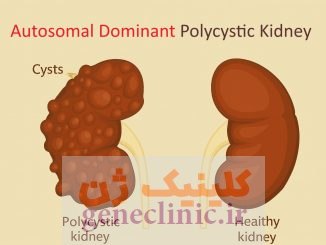 ‏کلیه پلی کیستیک اتوزومال غالب‏ (Autosomal dominant polycystic kidney) چیست؟