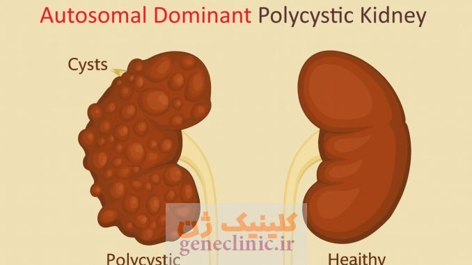 ‏کلیه پلی کیستیک اتوزومال غالب‏ (Autosomal dominant polycystic kidney) چیست؟