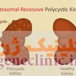 ‏کلیه های پلی کیستیک اتوزومال مغلوب‏ (Autosomal recessive polycystic kidneys) چیست؟