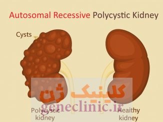 ‏کلیه های پلی کیستیک اتوزومال مغلوب‏ (Autosomal recessive polycystic kidneys) چیست؟
