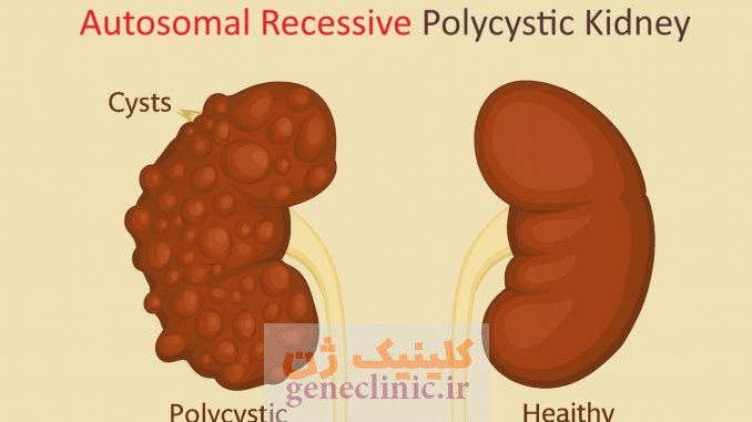 ‏کلیه های پلی کیستیک اتوزومال مغلوب‏ (Autosomal recessive polycystic kidneys) چیست؟