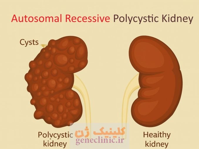 ‏کلیه های پلی کیستیک اتوزومال مغلوب‏ (Autosomal recessive polycystic kidneys) چیست؟