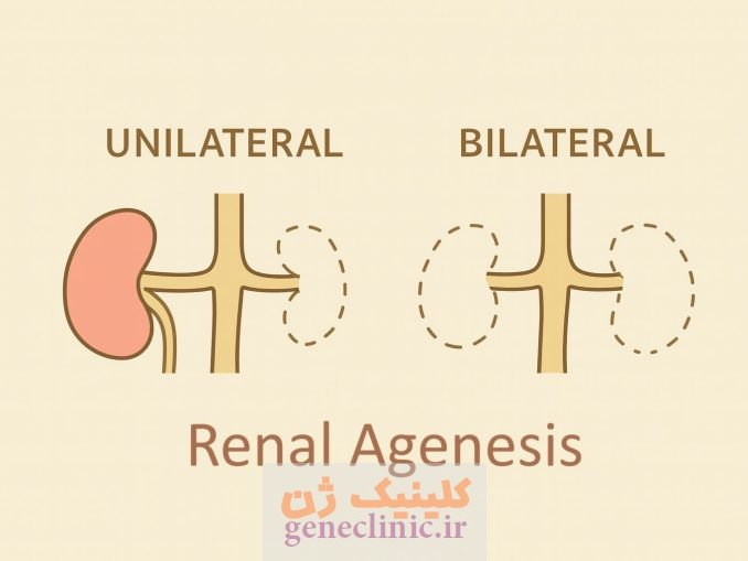 ‏آژنزی کلیه‏ (Renal agenesis) چیست؟