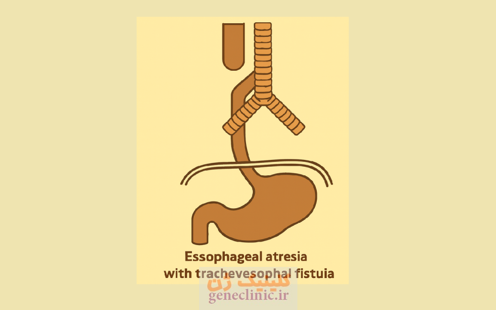 ‏آترزی مری‏ (Esophageal atresia) چیست؟