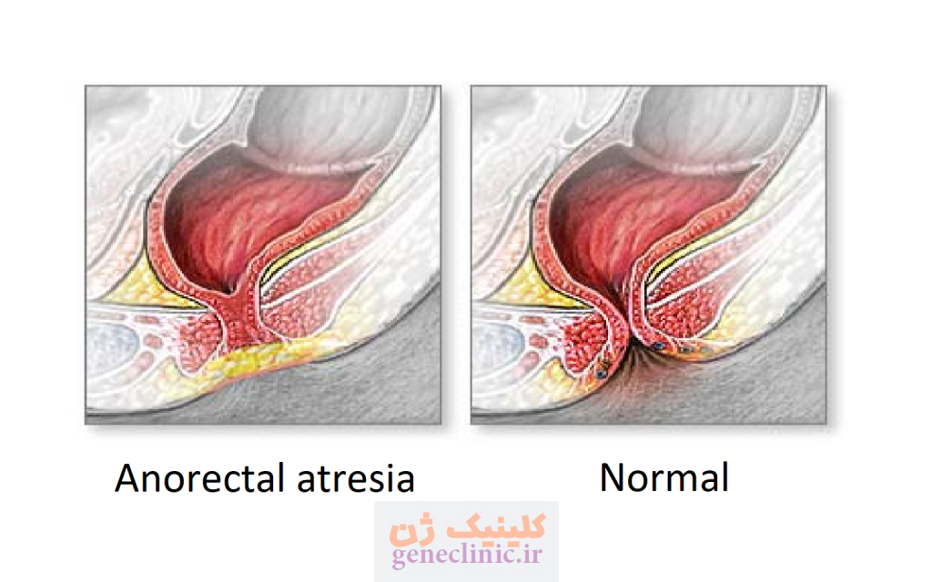 ‏آترزی آنورکتال‏ (Anorectal atresia) چیست؟