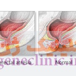 ‏آترزی آنورکتال‏ (Anorectal atresia) چیست؟