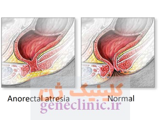 ‏آترزی آنورکتال‏ (Anorectal atresia) چیست؟