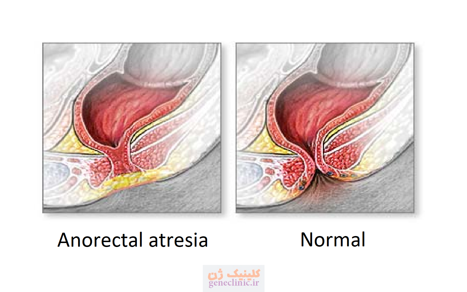 ‏آترزی آنورکتال‏ (Anorectal atresia) چیست؟